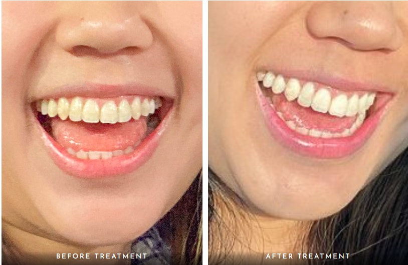 Snow Teeth Whitening before and after